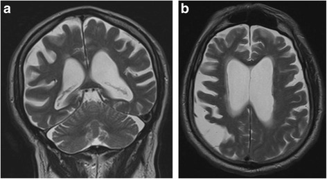 Obrazy MRI zaawansowanej choroby Alzheimera z rozległą utratą tkanki mózgowej.